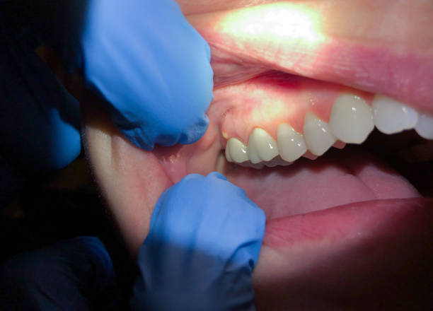 Best Emergency Denture Repair in Turner, OR